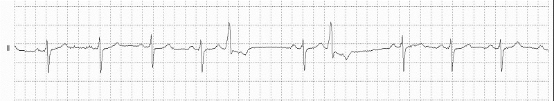 Ventricular Bigeminy Rhythm Strip